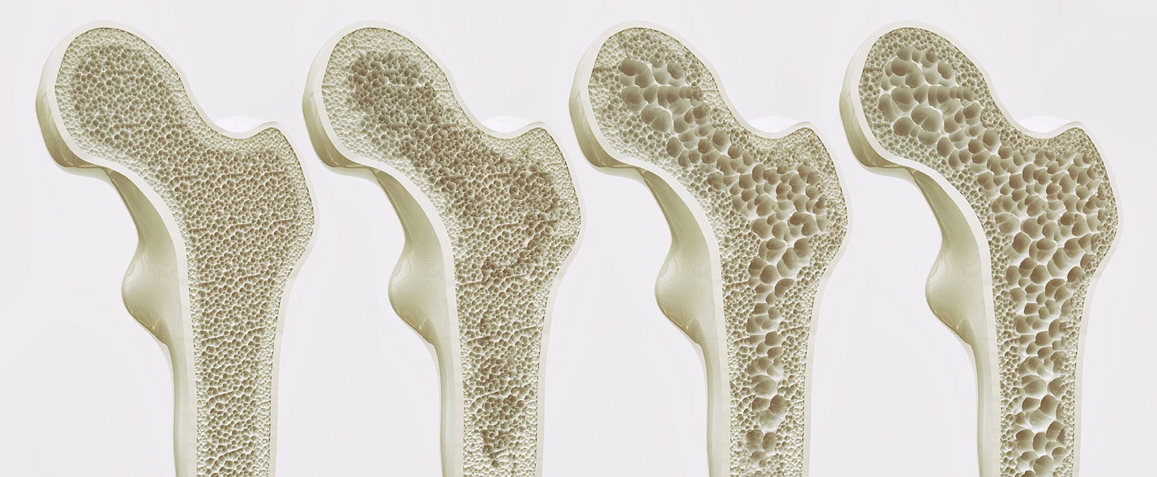 covid-19-and-fragility-fractures-apffa