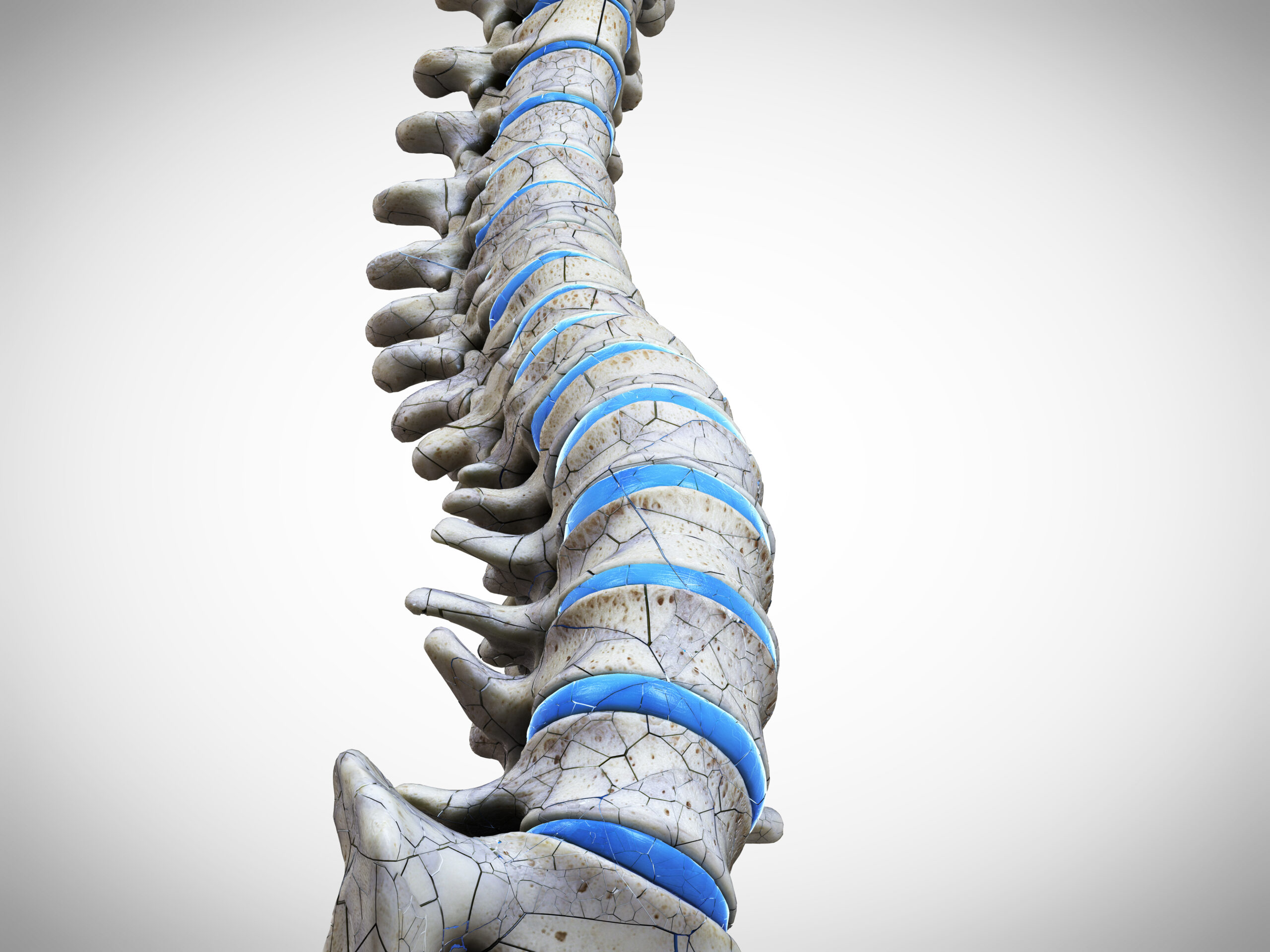 A case for DXA vertebral fracture assessment in Fracture Liaison ...