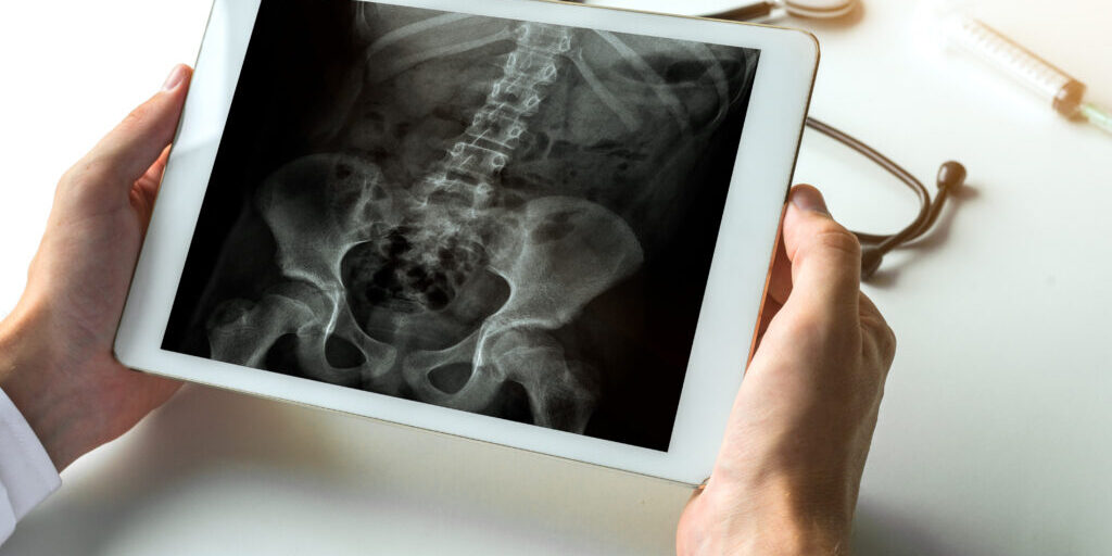 Doctor watching a x-ray of hips and spine for back pain on digital tablet.
