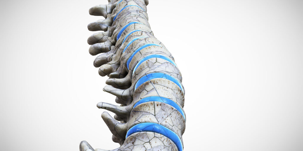 3d rendered medically accurate illustration of a broken spine