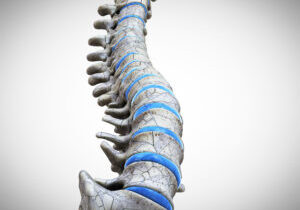 3d rendered medically accurate illustration of a broken spine 3d rendered medically accurate illustration of a broken spine