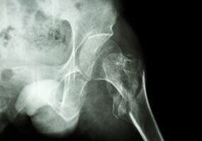 intertrochanteric fracture left femur film x-ray show intertrochanteric fracture left femur