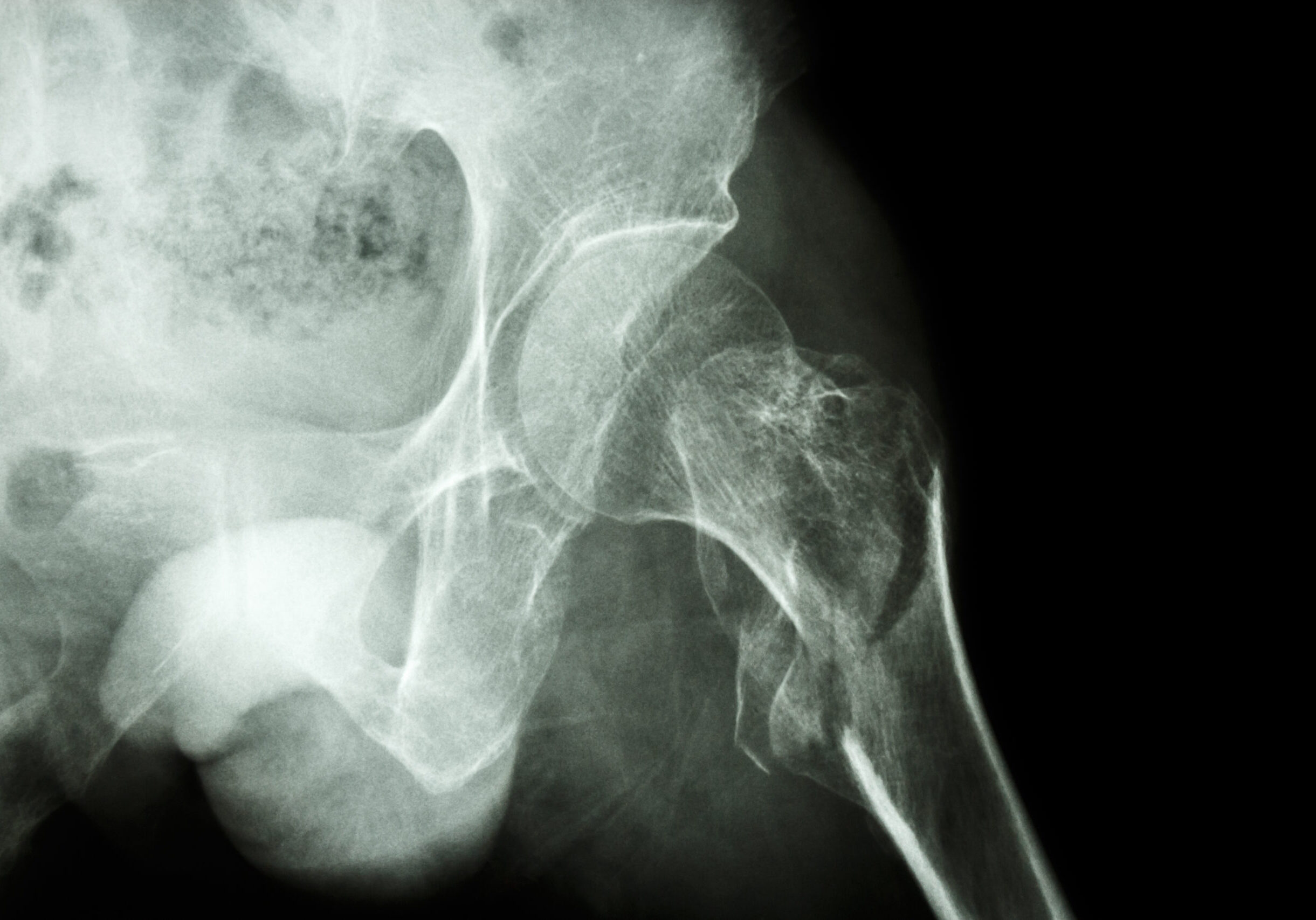 film x-ray show intertrochanteric fracture left femur